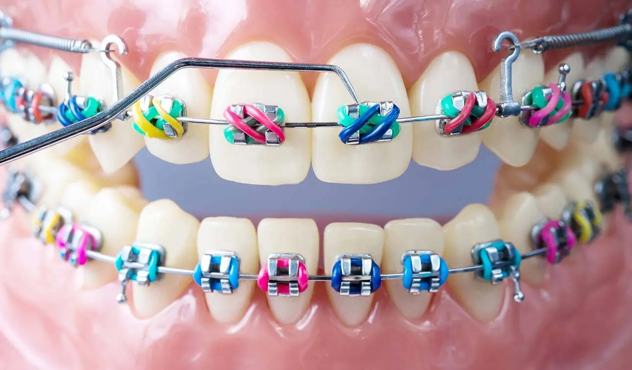 Fast tannregulering med brackets og reguleringsbue